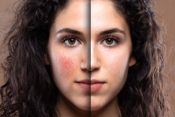 A beautiful young Caucasian woman is seen up-close before and after laser removal corrective...
