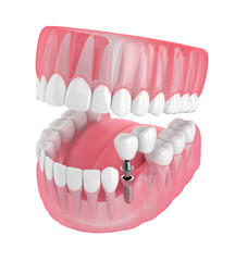 3d render of jaw with implant supported dental cantilever bridge
