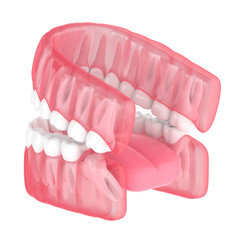 3d render of jaw with wisdom mesial impaction
