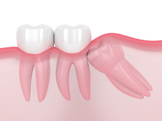 3d render of jaw with wisdom mesial impaction