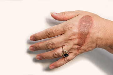Hand of senior woman with second degree injury thermal burn of skin after boiling water on white background. Home accident, careless behavior with boiling tea. On finger is jewel ring with blue stone