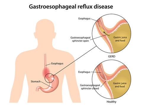 Gastroesophageal reflux disease stomach with main parts labeled. Medical vector illustration with the shape of sick human body, fragments of healthy and sick stomach isolated on white background