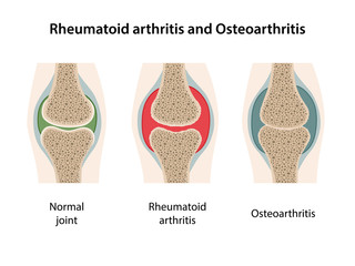 Rheumatoid arthritis and osteoarthritis of the joint. Images of healthy joint and diseased joints with main parts labeled. Vector illustration in flat style isolated over white background