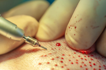 Patient's head close-up. Baldness treatment. Hair transplant. Surgeons in the operating room carry...