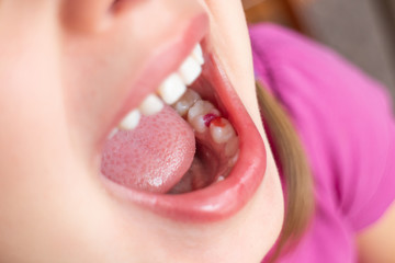 A girl showing her colorful filling in milk teeth. - 279179059