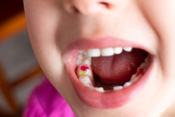 A girl showing her colorful filling in milk teeth. - 279179088