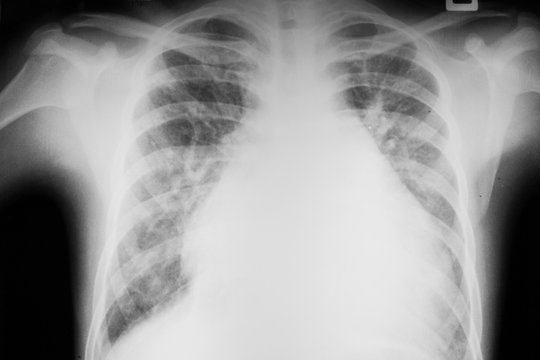 Chest x-ray image of dextrocardia and situs inversus patient that demonstrated heart,lungs,ribs,bones and muscles look like clearly film for diagnostic from radiologists in the hospital