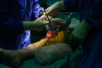 Team of doctor working at operating room in hospital. Surgeon perform total knee replacement surgery. Incision was made on patient 's knee in the case of osteoarthritis.Medical and orthopedic concept.