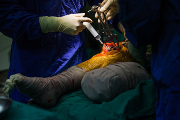 Team of doctor working at operating room in hospital. Surgeon perform total knee replacement surgery. Incision was made on patient 's knee in the case of osteoarthritis.Medical and orthopedic concept.