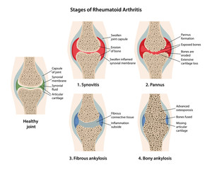 Rheumatoid arthritis stages of the joint with main parts labeled. Images of healthy joint and diseased joints with main parts labeled, isolated on white background. Vector illustration