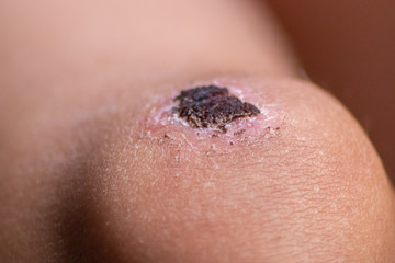 Heilende Schürfwunde am Knie von einem Kind mit Resten der Kruste und neuer, regenerierter Haut