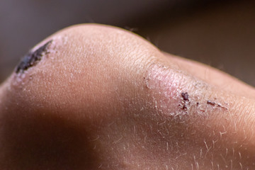 Heilende Schürfwunde am Knie von einem Kind mit Resten der Kruste und neuer, regenerierter Haut