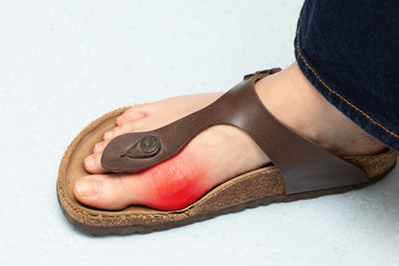 Naklejka premium Close up of female foot suffering from hallux valgus, red color highligts bunion zone