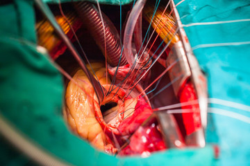 Mitral valve orifice in surgeon view. The pathologic mitral valve was dissected. The mitral valve ring was prepare before mitral valve replacement procedure perform.