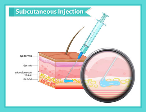 Scientific medical illustration of subcutaneous injection