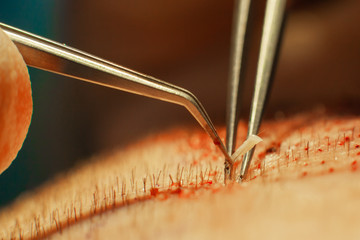 Macrophotography of a hair bulb transplanted into a hairless area. Baldness treatment. Hair...