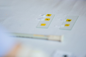 Doctor check blood group of patient or donor by mixing the sample with reagent