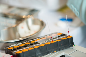 Doctor check blood group of patient or donor by mixing the sample with reagent