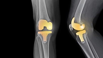 Film X-ray knee radiograph showing degenerative osteoarthritis (OA knee disease) treated by total knee replacement surgery ( TKR ) or joint prosthesis and free copy space. Medical technology concept.