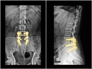 Film x-ray radiograph lumbar spine showing spinal stenosis treated by decompressive laminectomy with fusion and  fixation with pedicle screw and rod . Highlight on implant. Medical technology concept.