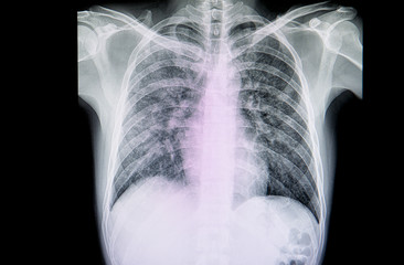 A chest xray film of a patient with  severe pneumonia