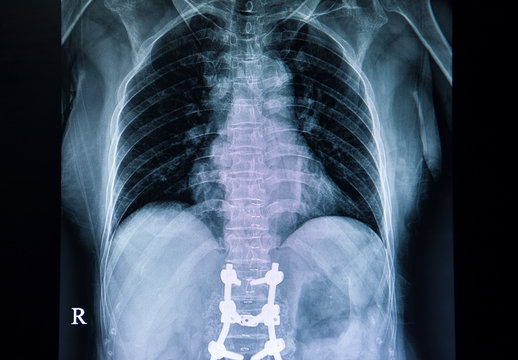 Xray film of a back of a patient with laminectomy
