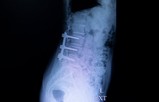 Xray film of a back of a patient with laminectomy