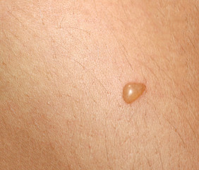 Bubble on the skin. Blister on the skin.