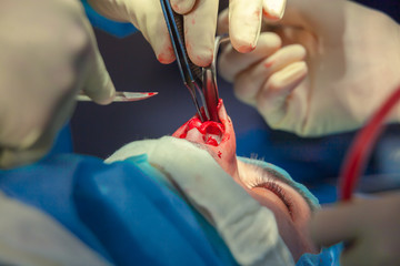 Surgeon and his assistant performing cosmetic surgery on nose in hospital operating room. Nose...