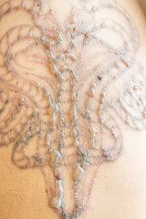 Blisters on Body from Laser Tattoo Removal