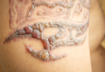 Blisters on Male Arm from Laser Tattoo Removal
