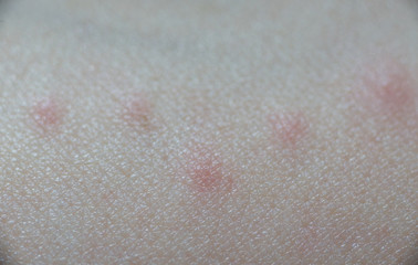 Red wheal on skin that effect from insect bite