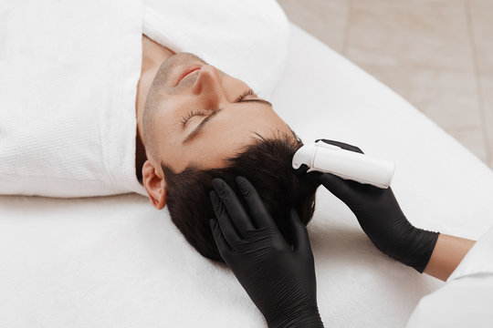  Face microneedling treatment with a meso roller.