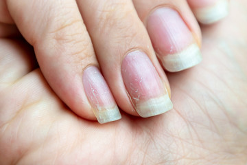 Damaged nails that have problem after doing manicure. Health and beauty problem. - obrazy, fototapety, plakaty