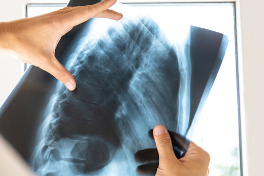 doctor examines x-ray picture of human spine and chest