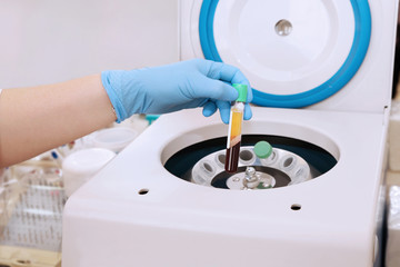 Medical tube with blood plasma in hand for PRP, extracted from centrifuge for plasma lifting