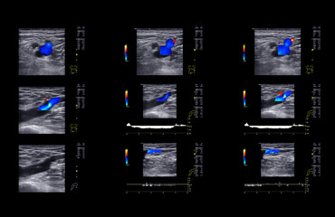 Ultrasound doppler for finding  deep vein thrombosis of lower extremity.