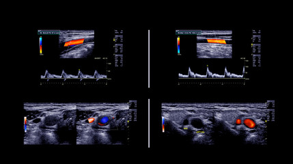 Ultrasound doppler for finding  deep vein thrombosis.