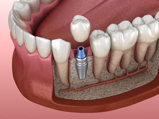 Premolar tooth crown installation over implant abutment. Medically accurate 3D illustration of human teeth and dentures concept