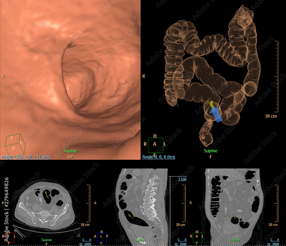 Poster ct colonography compare 2d axial,sagittal ,coronal plane and 3d rendering image for screening colore