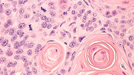 Lung Cancer: Photomicrograph of a CT (CAT) scan-guided needle core biopsy showing pulmonary...