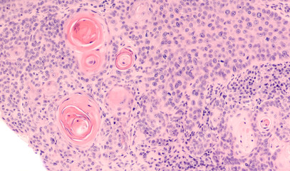 Lung Cancer: Photomicrograph of a CT (CAT) scan-guided needle core biopsy showing pulmonary...