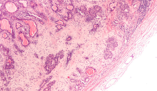 Photomicrograph of a pleomorphic adenoma (benign mixed tumor), of salivary glands such as parotid and submandibular glands, with both epithelial and mesenchymal (eg chondromyxoid) components.