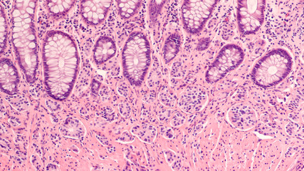 Photomicrograph of a carcinoid tumor, a type of neuroendocrine tumor (NET), which presented as a...