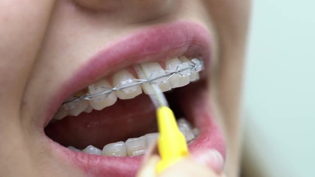 Cleaning of patient's teeth brackets in dental clinic