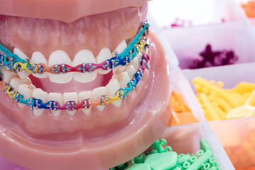Close up  orthodontic model  - demonstration teeth model of varities of orthodontic bracket or brace