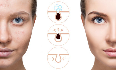 Graphically shows how to pollute and clean the pores on face.