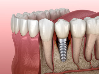 Periimplantitis with visible bone damage. Medically accurate 3D illustration of dental implants concept