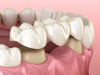 Dental bridge of 3 teeth over molar and premolar. Medically accurate 3D illustration of human teeth treatment