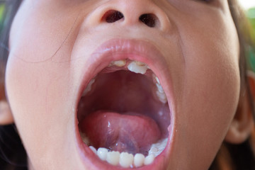 Stacked front tooth, a problem with children, parents should take to see the dentist.